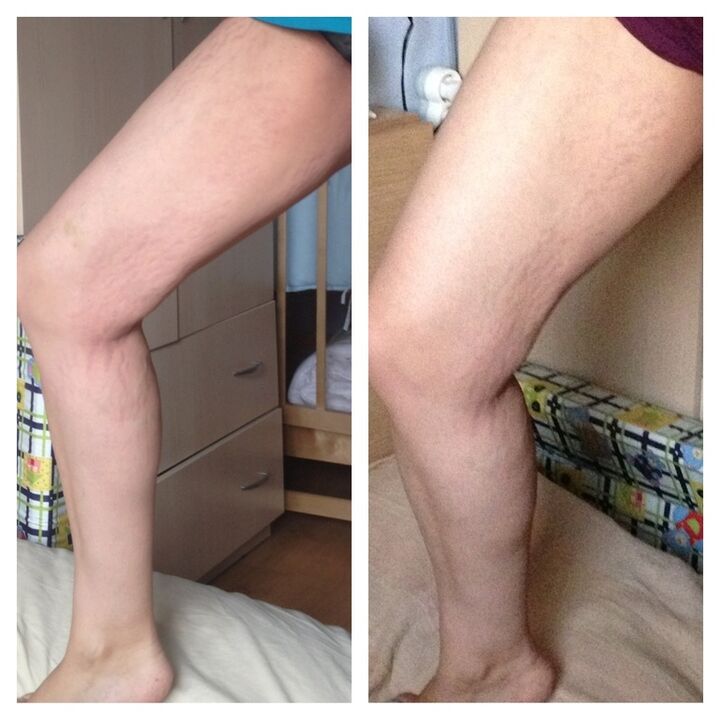 коліно до і після
